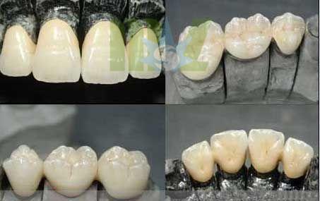 Cobalt-chromium porcelain teeth which harm