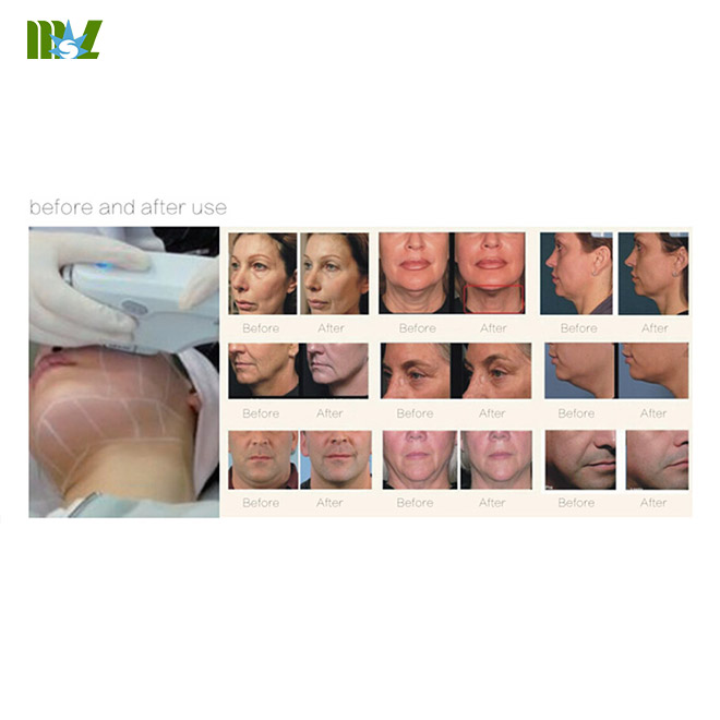 MSL High intensity focused ultrasound MSLHF01