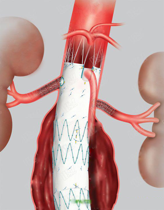 endovascular aortic aneurysm repair