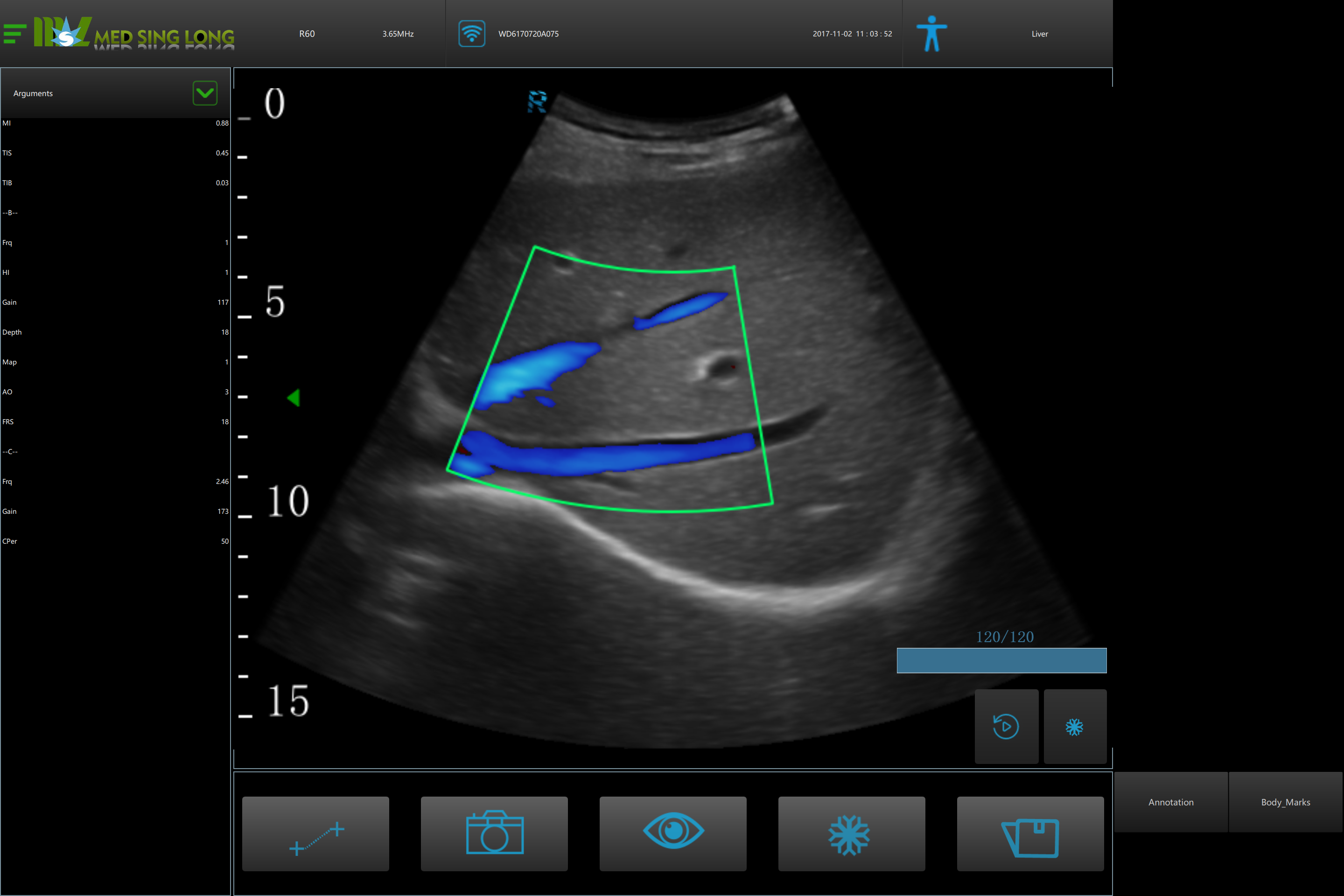 doppler ultrasound