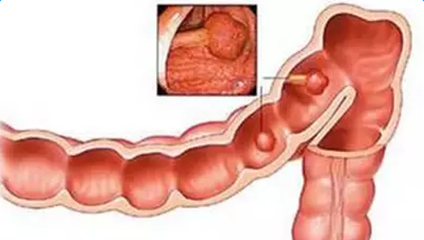 colon cancer symptoms