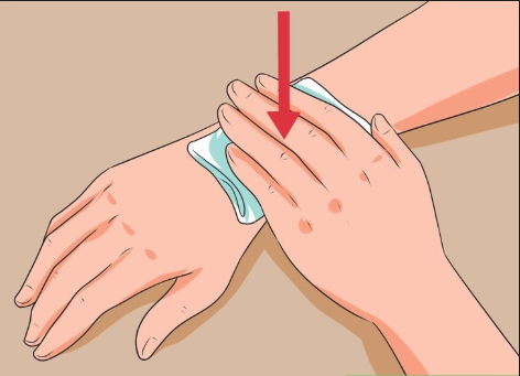 How to speed up healing bruises