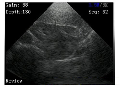 ultrasound imaging