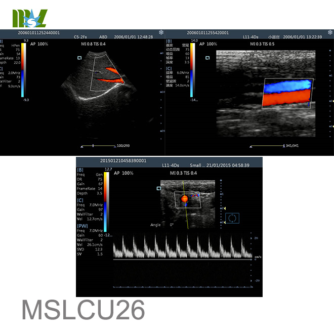 Color Doppler Ultrasound