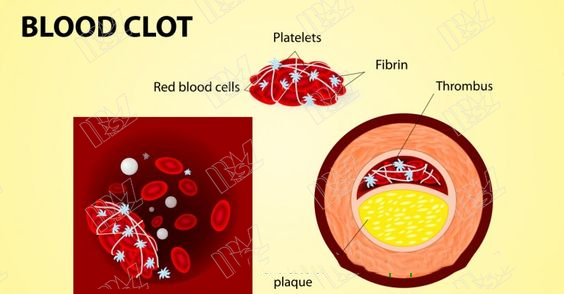 blood clots