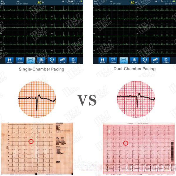 ECG