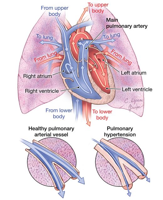 hypertension pathogenesis