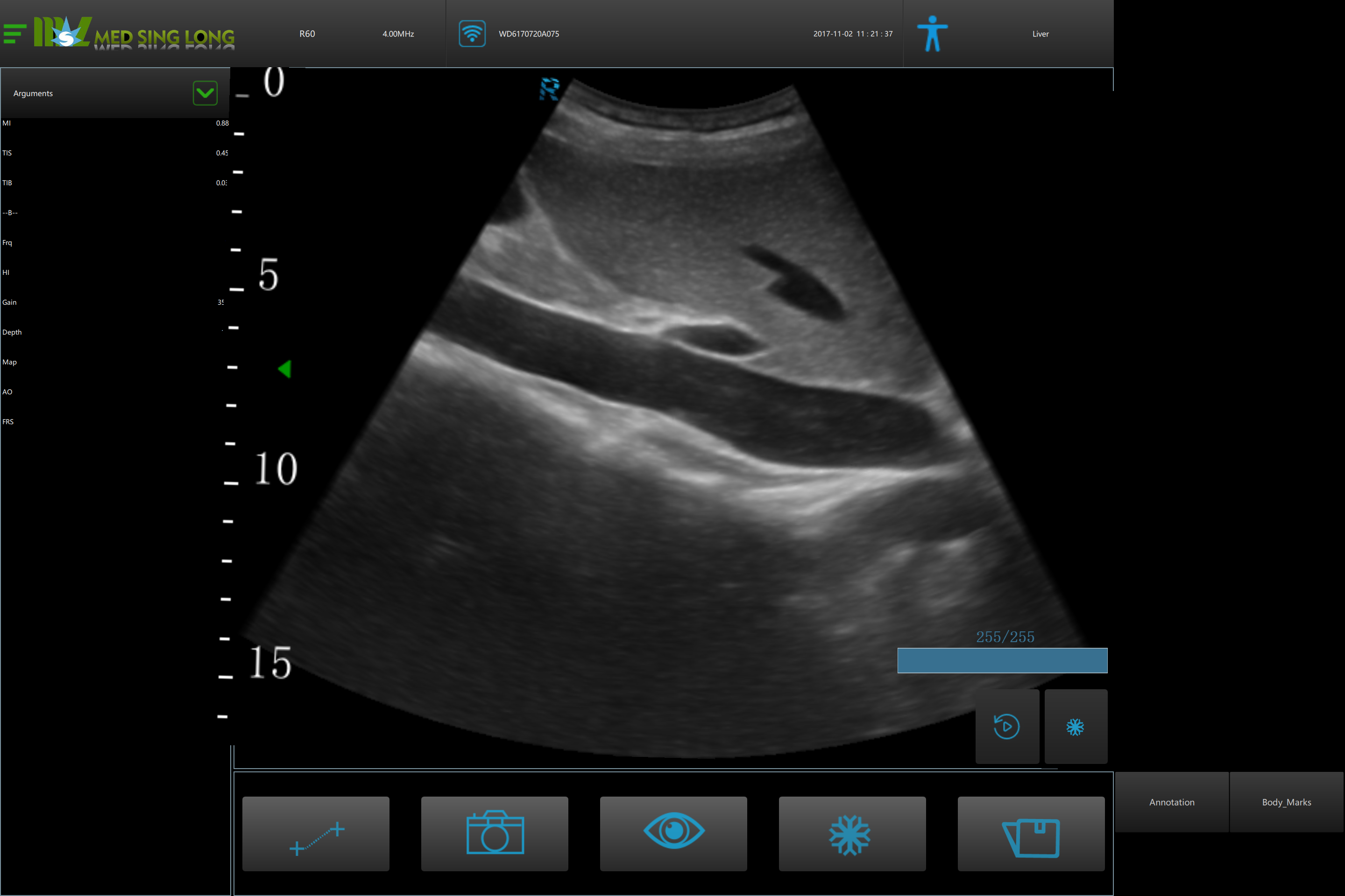 why ultrasound with full bladder