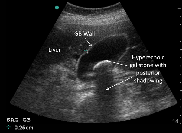 will ultrasound show gallstones