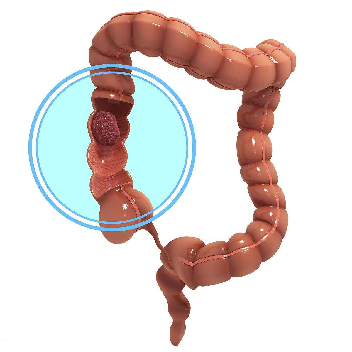 Medsinglong colonoscopy