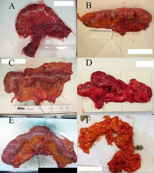 Medsinglong bronchoscopy