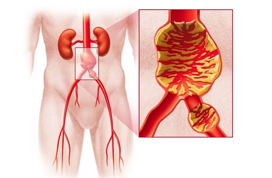 abdominal aortic aneurysm