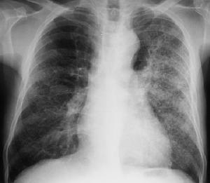 Bacterial pneumonia