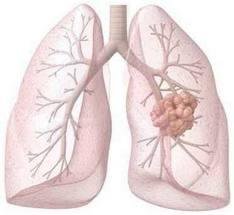 lung cancer symptoms