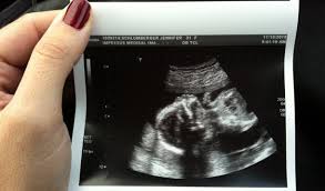 gender ultrasound