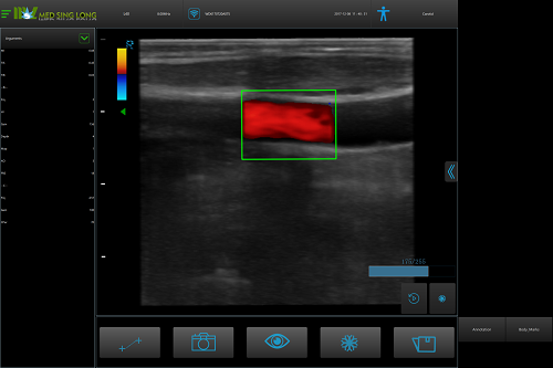 arterial doppler