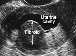 What is sonohysterography