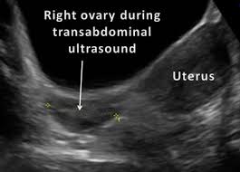 pelvic ultrasound