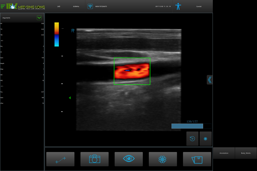 Carotid ultrasound