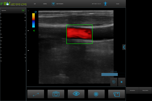 carotid ultrasound