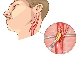 carotid ultrasound