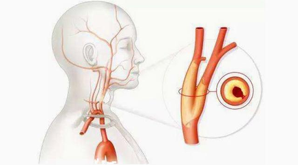 carotid ultrasound