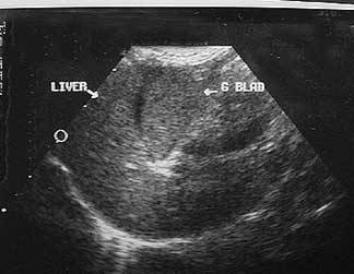 liver ultrasound