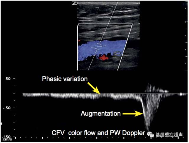 venous doppler