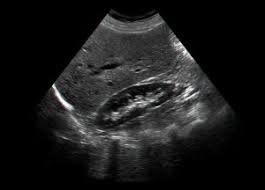 renal ultrasound