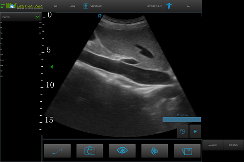 ultrasound examination