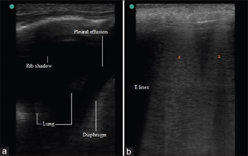 Pulmonary ultrasound